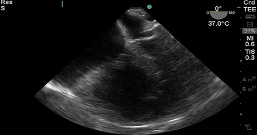 Cardiac Imaging 2 - Transesophageal Echocardiography (TEE